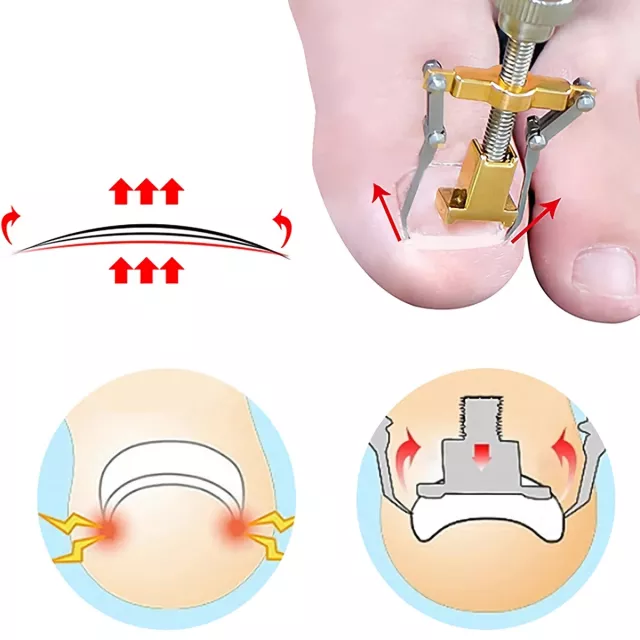 Professional Ingrown Toenail Treatment Set with Correction Patches and Pedicure Tools - Image 4