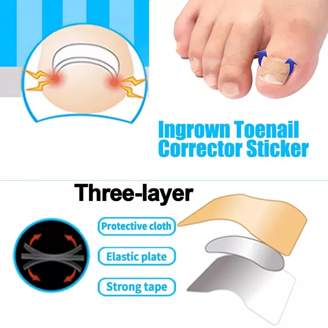 Professional Ingrown Toenail Treatment Set with Correction Patches and Pedicure Tools - Image 3