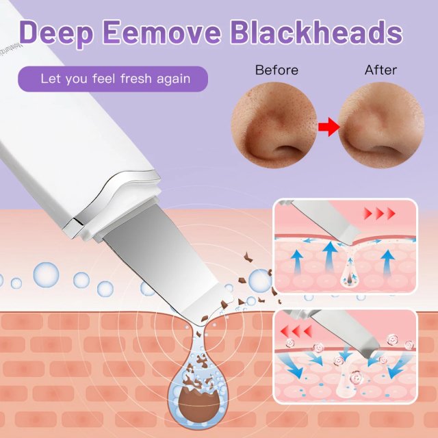 Ultrasonic Skin Scrubber - Image 6