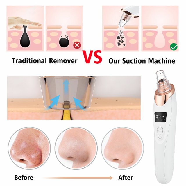 Electric Blackhead Remover Vacuum Cleaner with Deep Cleansing and Pore Extraction - Image 4